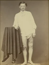 Verletzter Soldat des Bürgerkriegs (Private Charles Westerfield, Army Medical Museum Specimen No. 4278), April 1865